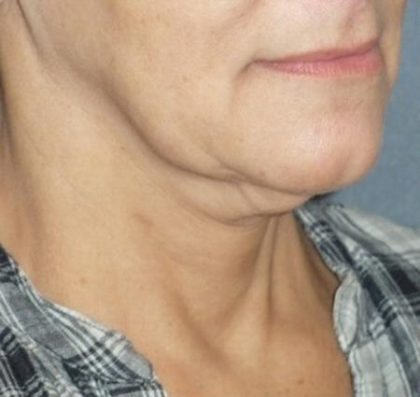 Mini With Necklift Before & After Patient #84