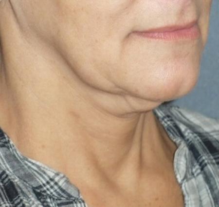 Mini With Necklift Before & After Patient #84