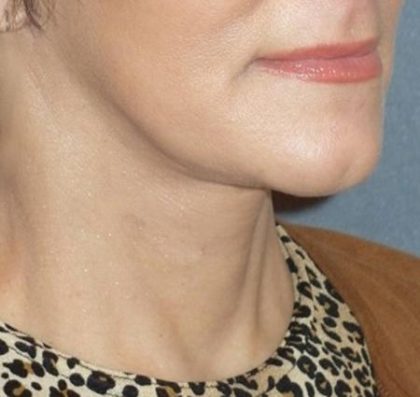 Mini With Necklift Before & After Patient #84