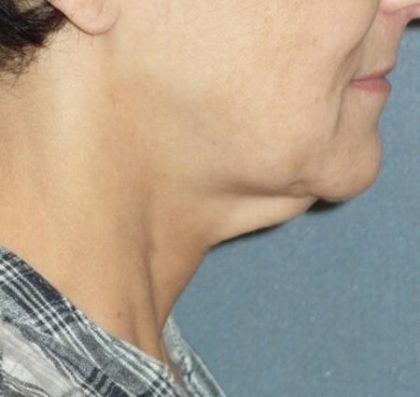 Mini With Necklift Before & After Patient #84
