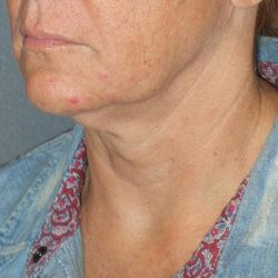 Mini With Necklift Before & After Patient #81