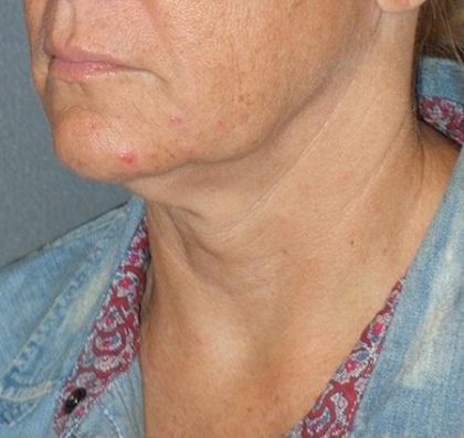 Mini With Necklift Before & After Patient #81
