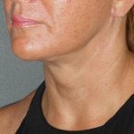 Mini With Necklift Before & After Patient #81