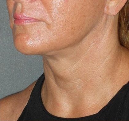 Mini With Necklift Before & After Patient #81