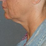 Mini With Necklift Before & After Patient #81