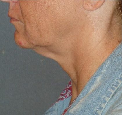 Mini With Necklift Before & After Patient #81