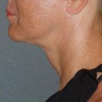 Mini With Necklift Before & After Patient #81