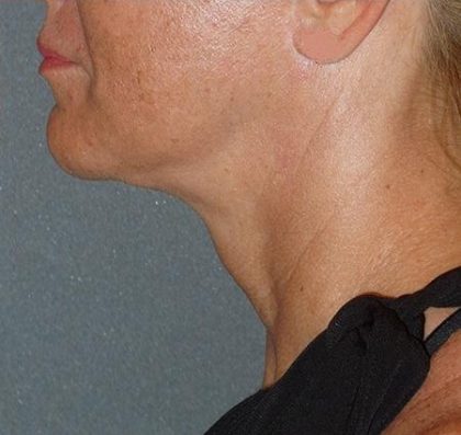 Mini With Necklift Before & After Patient #81