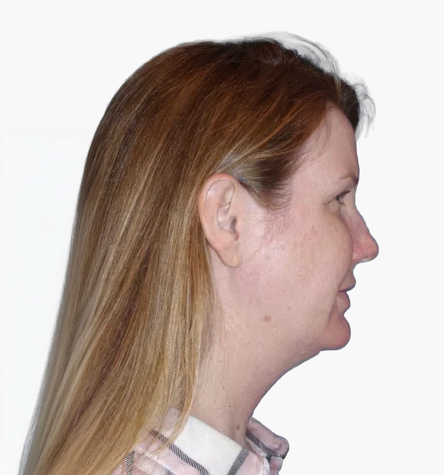 Facial rejuvenation patient result, before