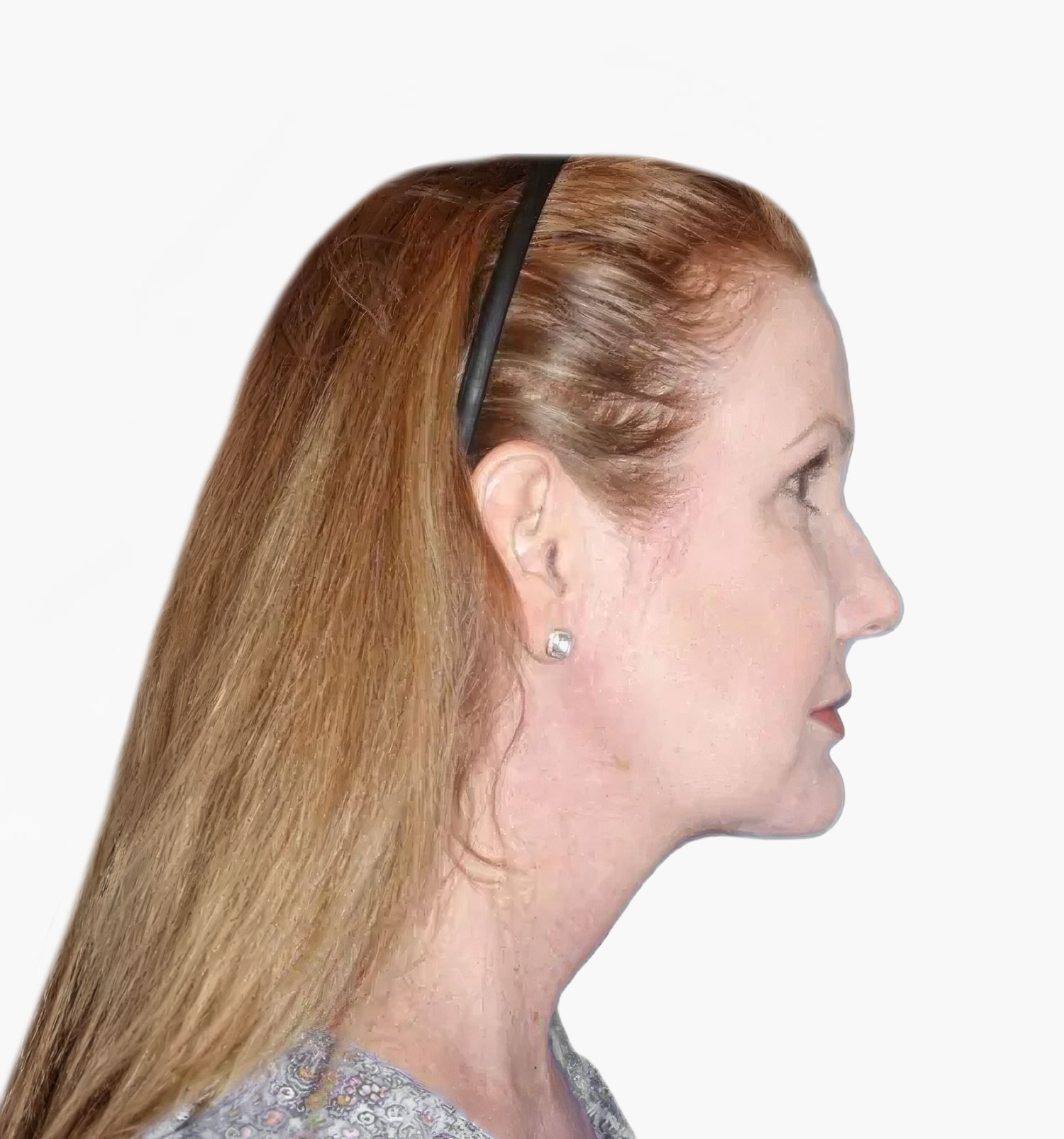 Facial rejuvenation patient result, after