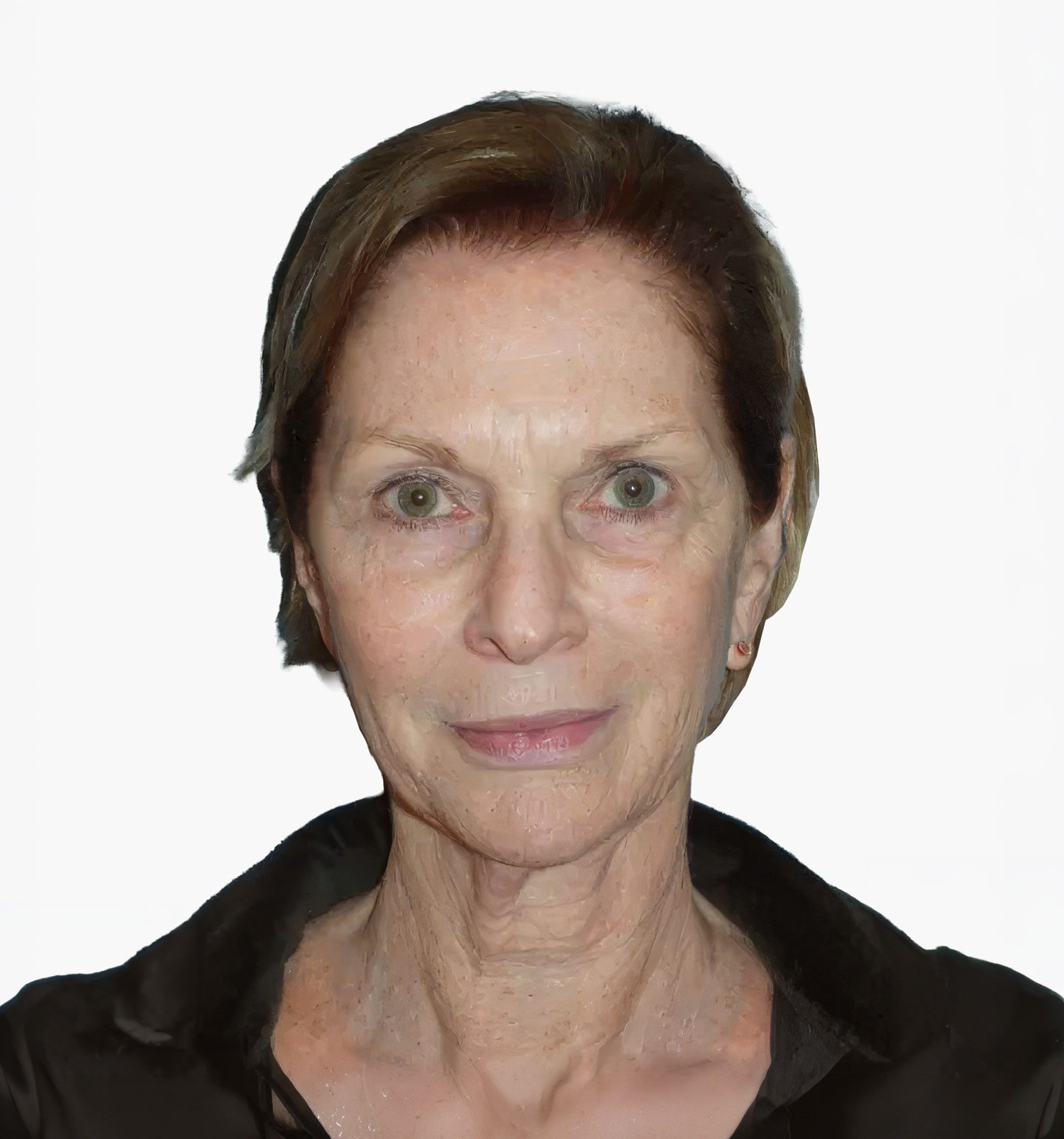Facial rejuvenation patient result, before