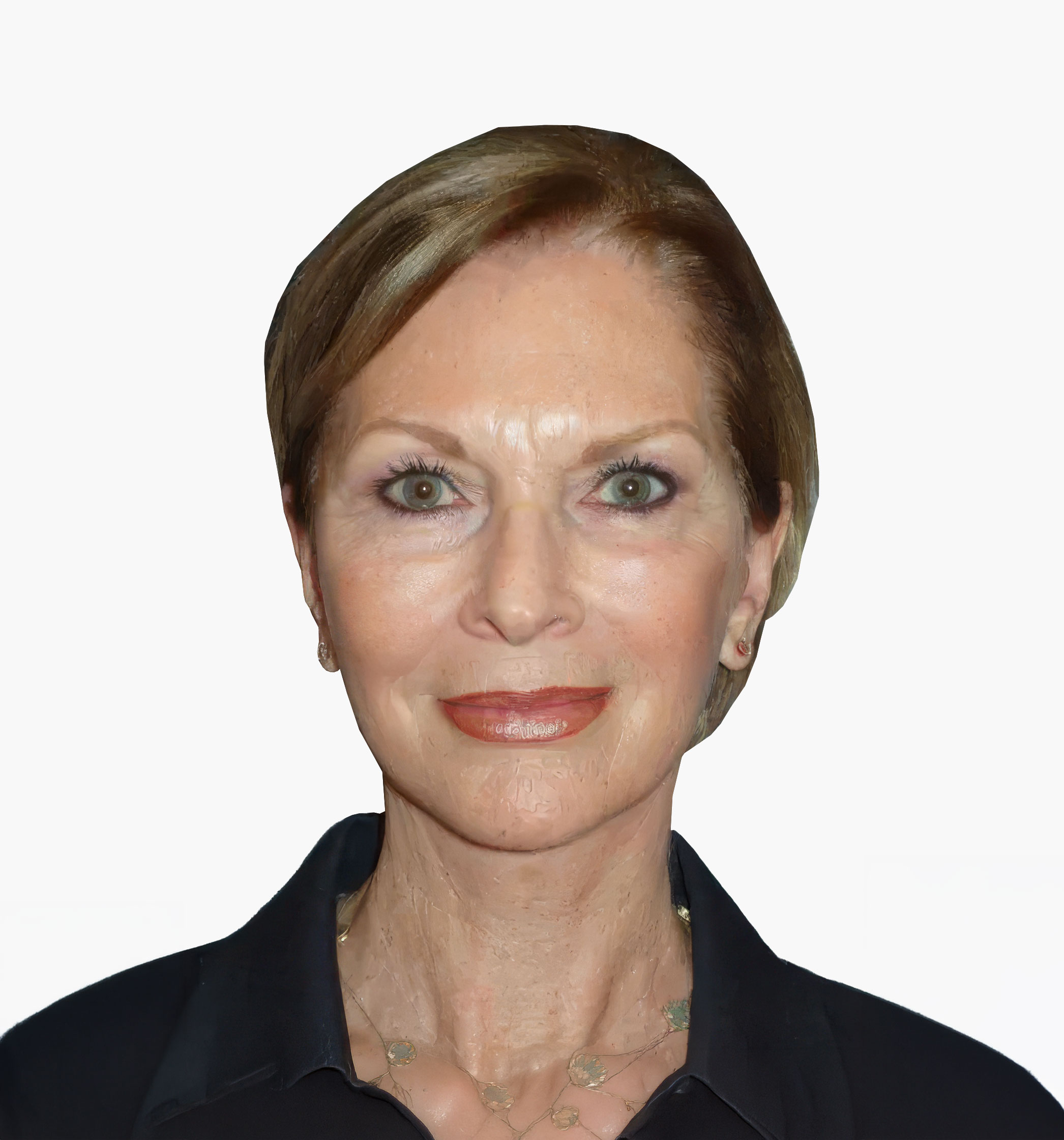 Facial rejuvenation patient result, after